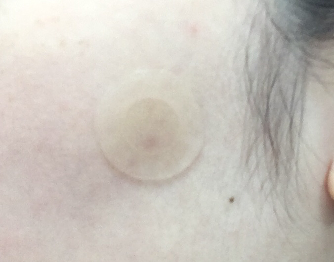 Real user review photo of Madecassoside Needle Spot Patch