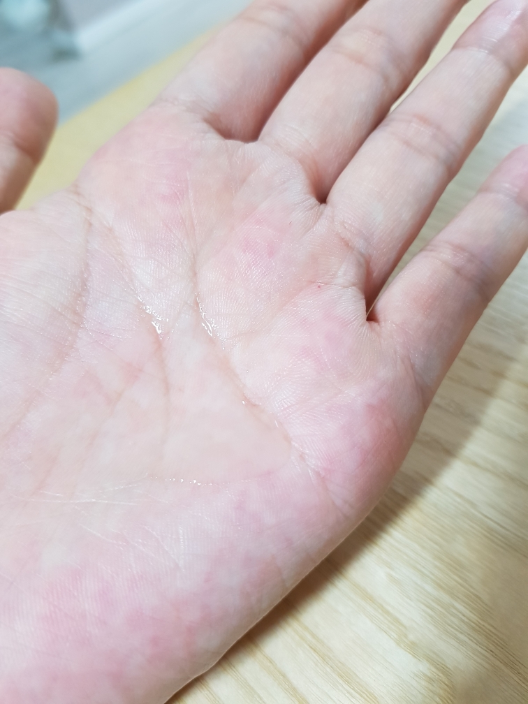 恢复系统皮肤的真实用户使用照片