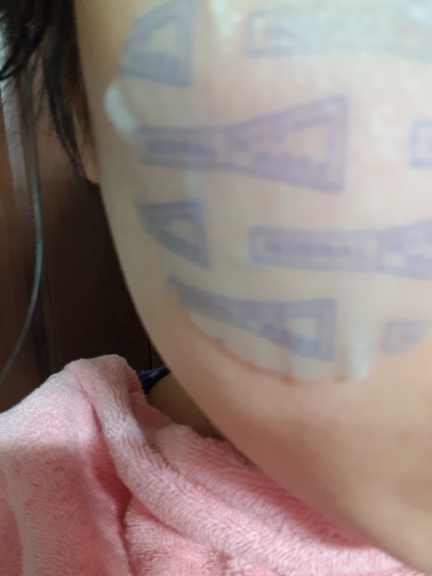 蓝色疗法抗红镇静贴片的真实用户使用照片