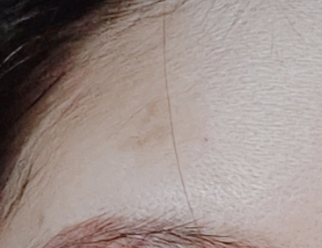 Real user review photo of Blemish Patch