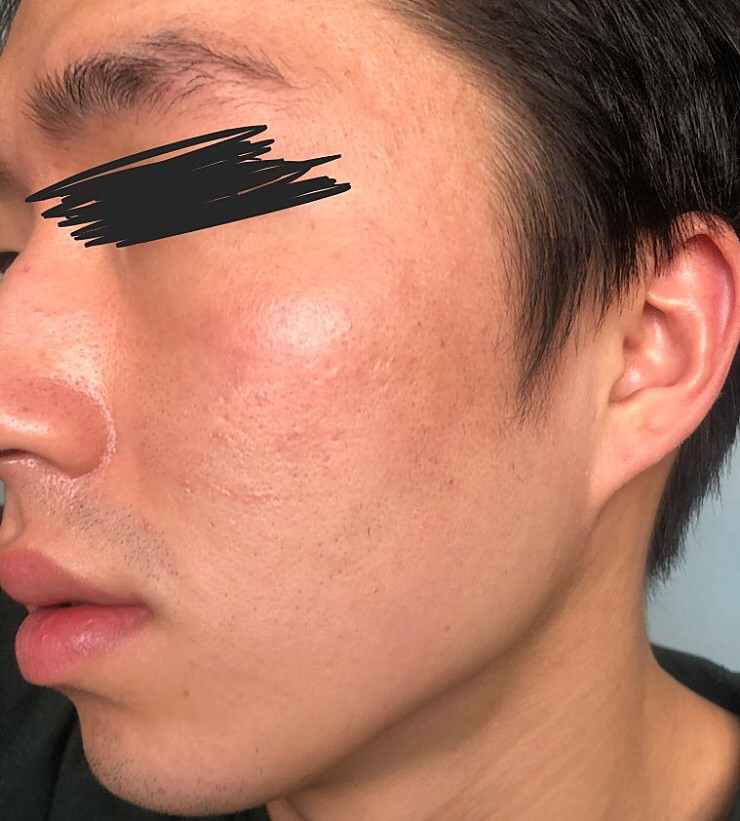 希卡复活霜 2代的真实用户使用照片
