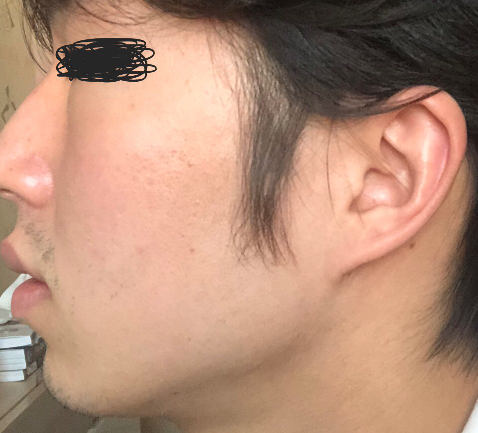 希卡复活霜 2代的真实用户使用照片