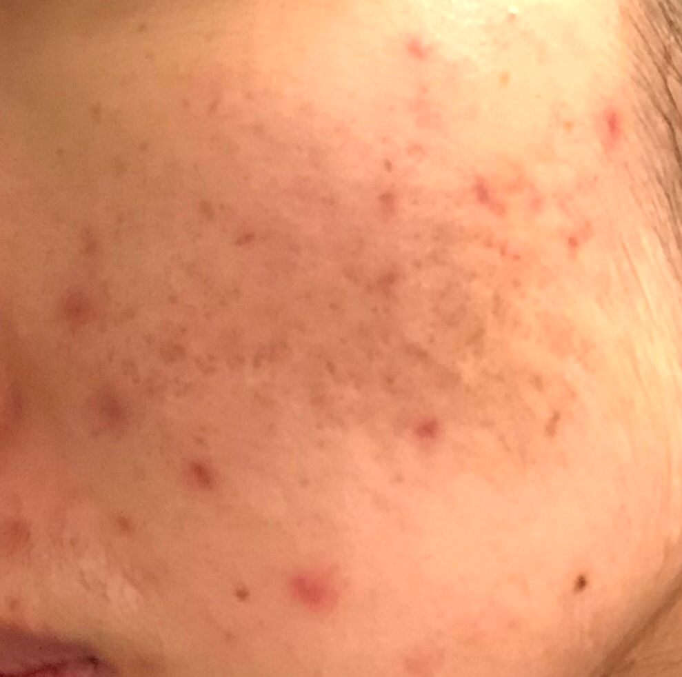 dermae 海外斯卡凝胶 common.review image