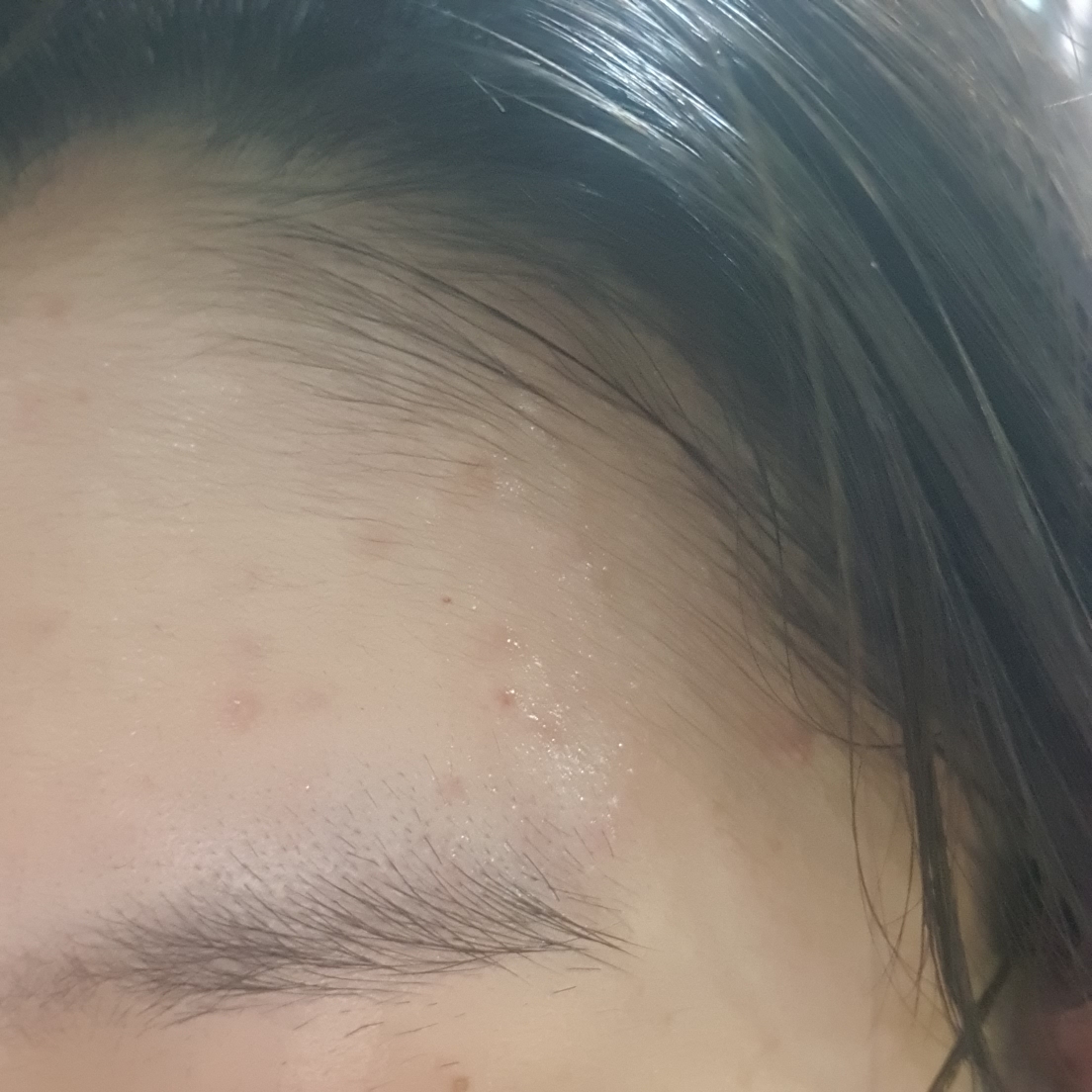 暗疮护理 [色斑护理］的真实用户使用照片