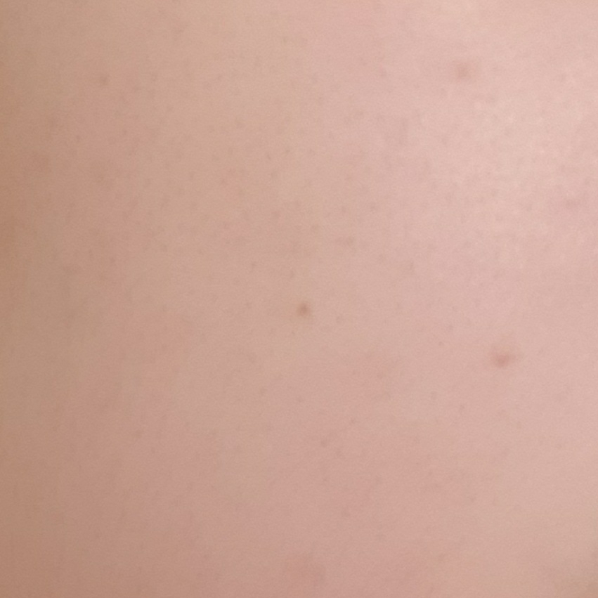 暗疮护理 [色斑护理］的真实用户使用照片