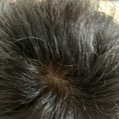 VHAIREXPERT 皮肤科脱发缓解头皮营养液 common.review image