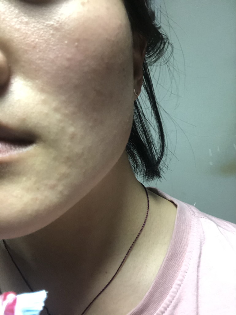 DEMAR3 Flucion 17 crème common.review image