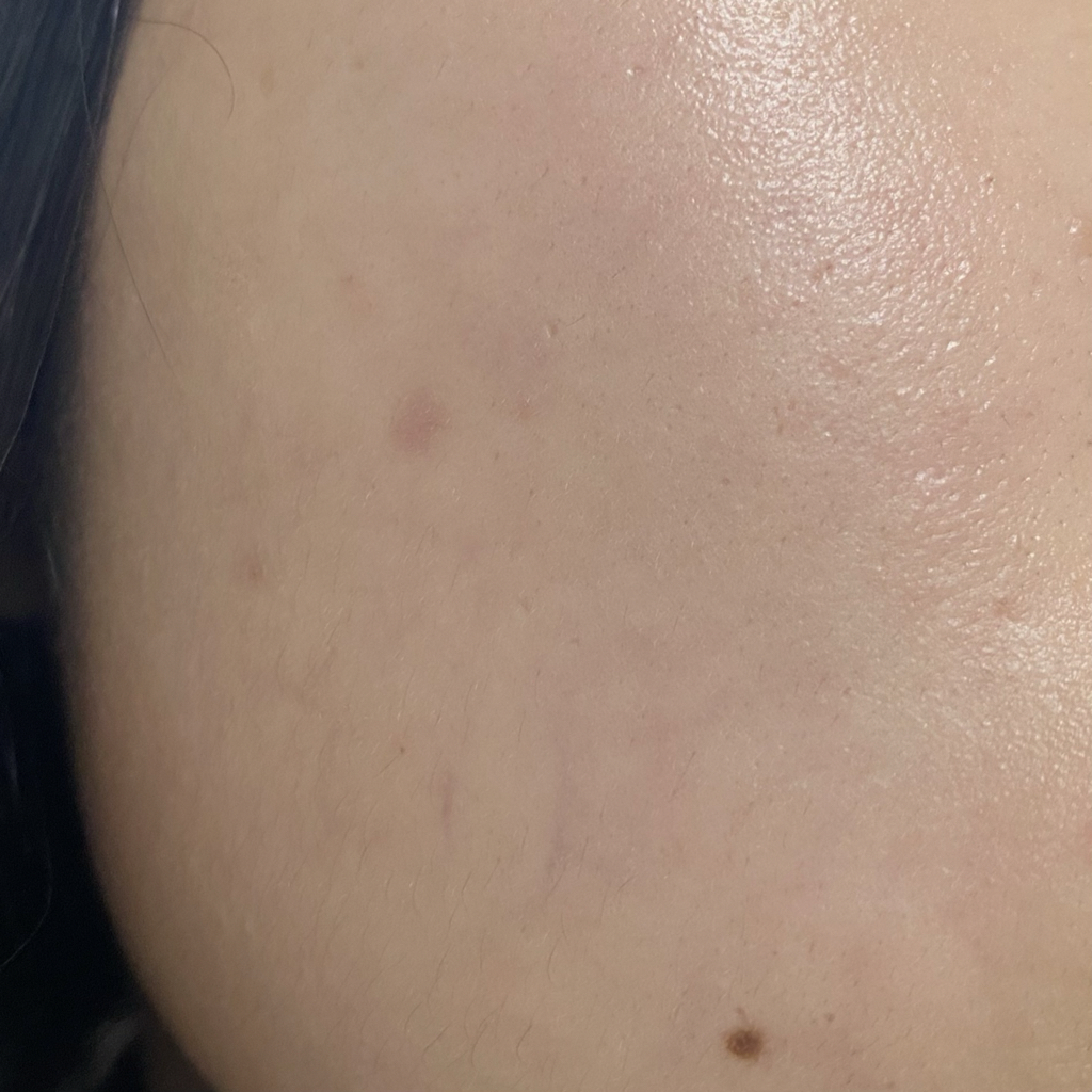 byeod-td 暗疮护理 [色斑护理］ common.review image
