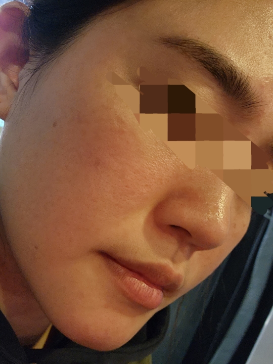 水解角质安瓶的真实用户使用照片