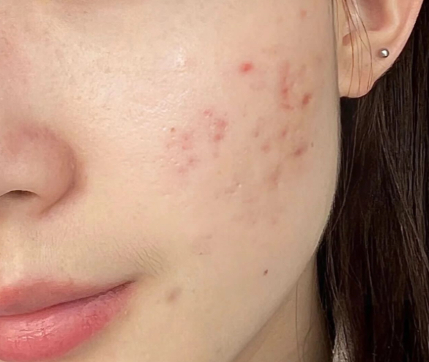 斐得药芳 阿克奈洗液 23 安瓿 common.review image