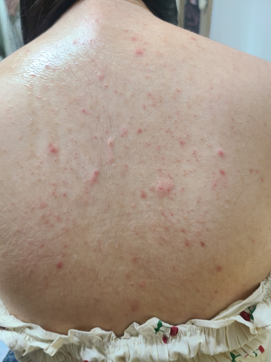 露水生物降解祛痘沐浴露的真实用户使用照片