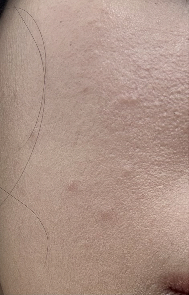 04 Endermic 5MJEFF 乳霜的真实用户使用照片