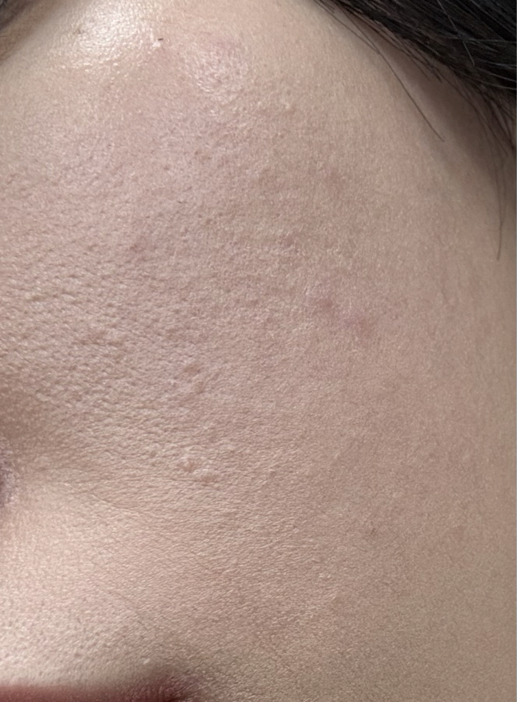 04 Endermic 5MJEFF 乳霜的真实用户使用照片