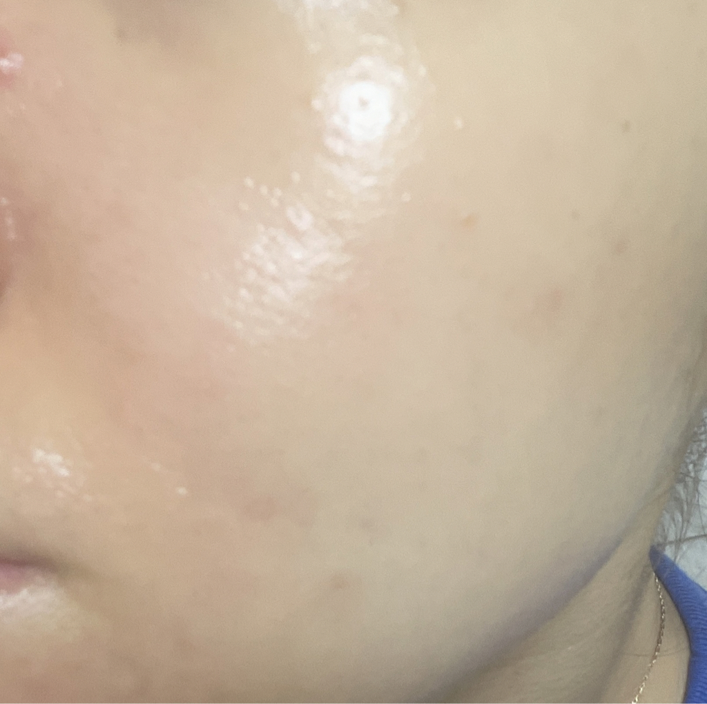 视黄醇0.5安瓿的真实用户使用照片