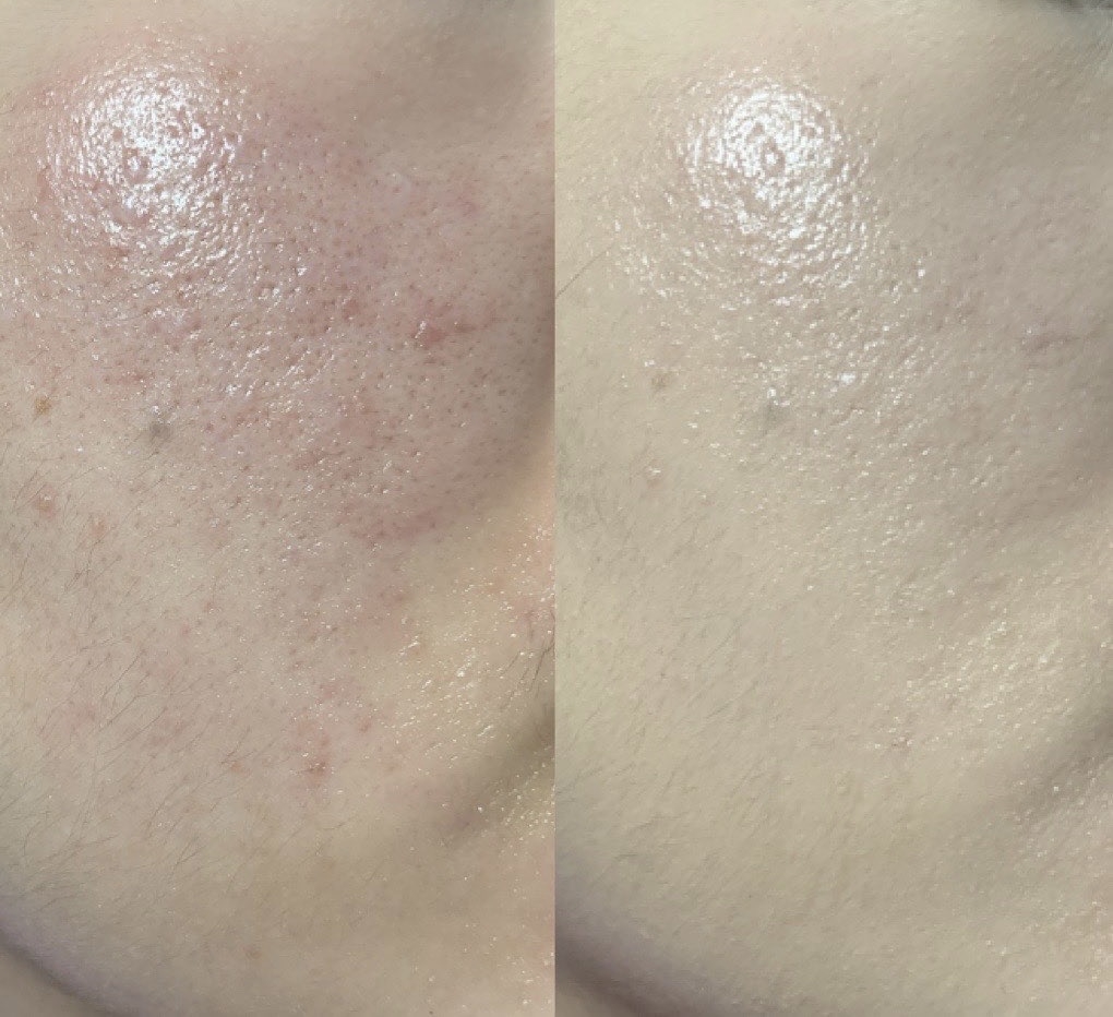 初源100深层卸妆油的真实用户使用照片