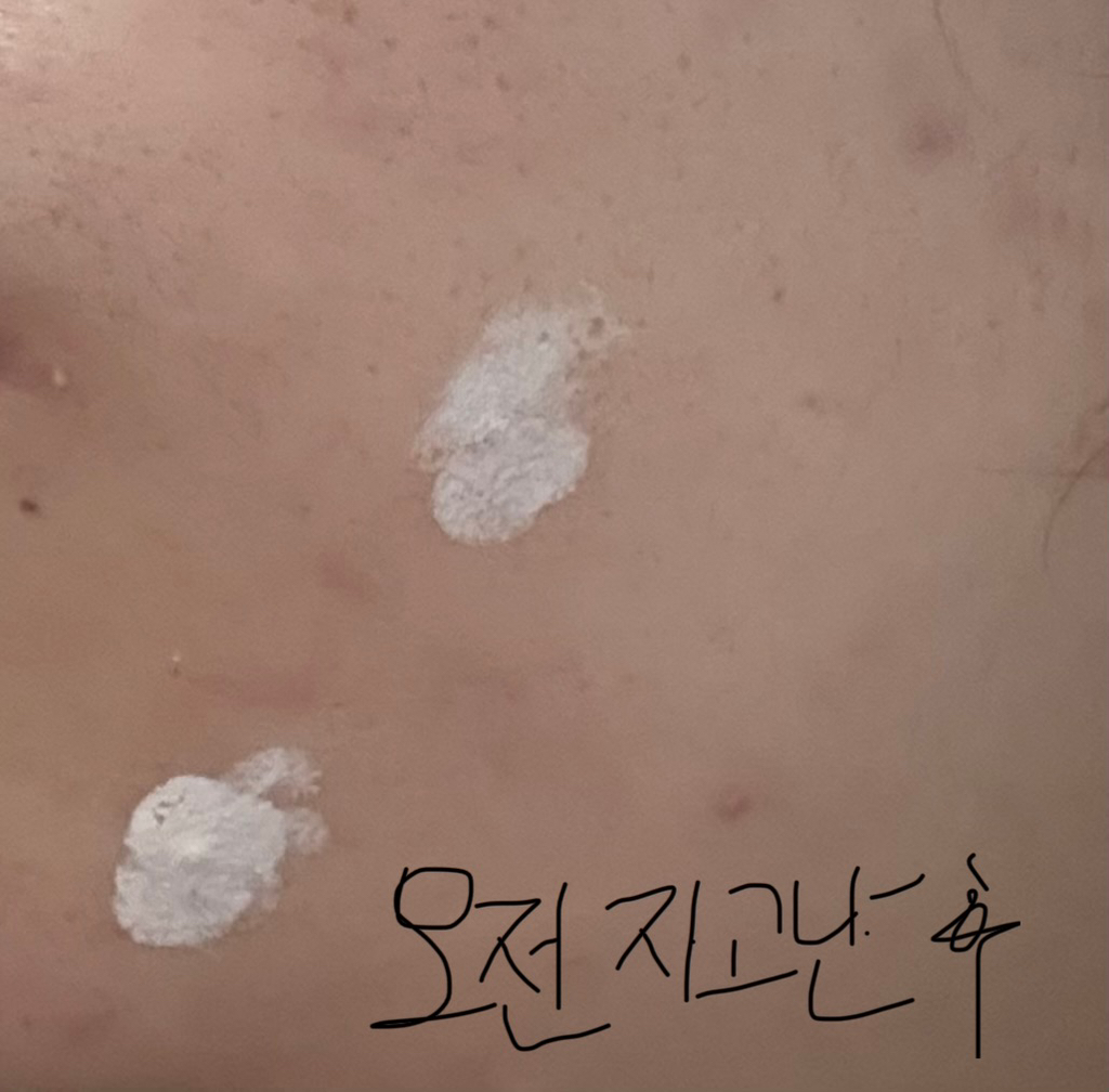 控制A™ 茶树疗程舒缓护理的真实用户使用照片