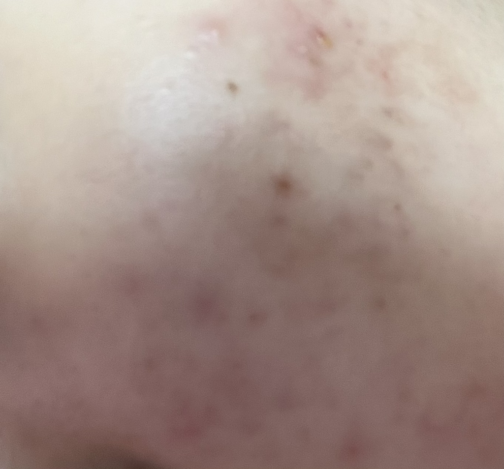 Real user review photo of AC CTRL EX DEEP BLEMISH CALMING PAD