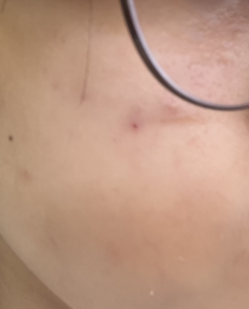 Real user review photo of AC CTRL EX DEEP BLEMISH CALMING PAD