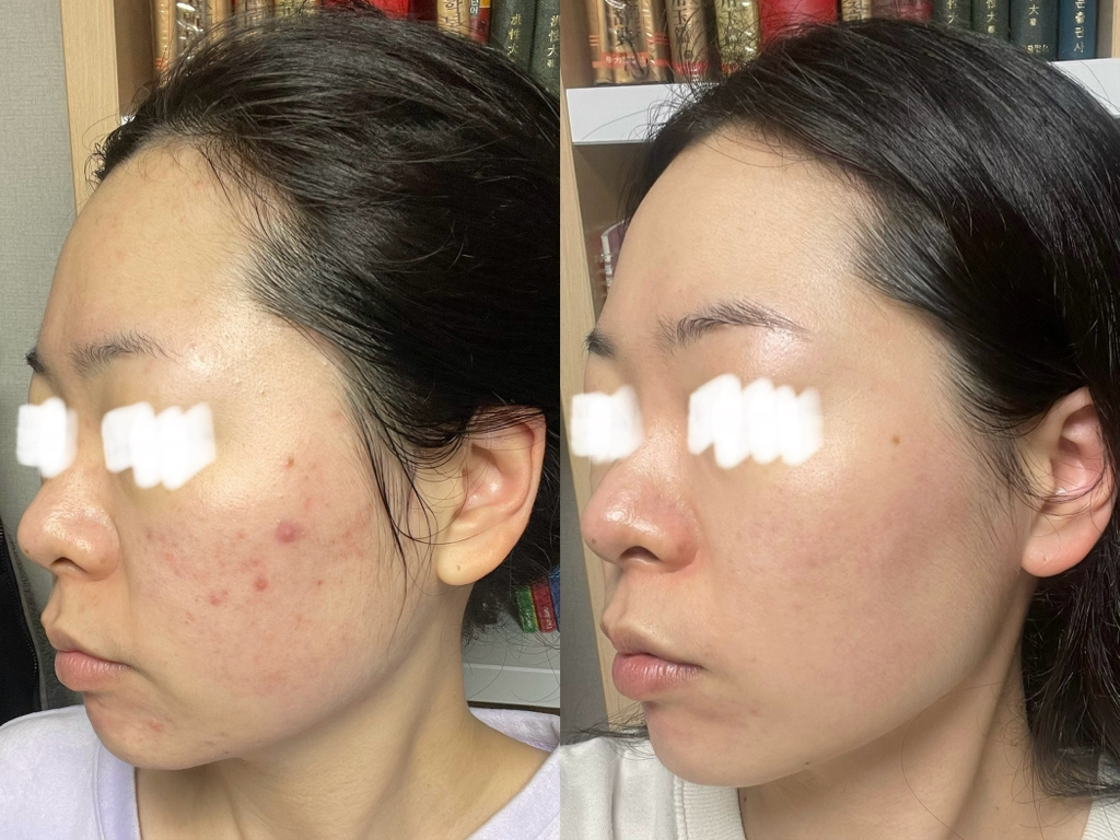 玻尿酸保湿+舒缓霜的真实用户使用照片