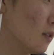 Real user review photo of ZINC TECA BLEMISH SERUM